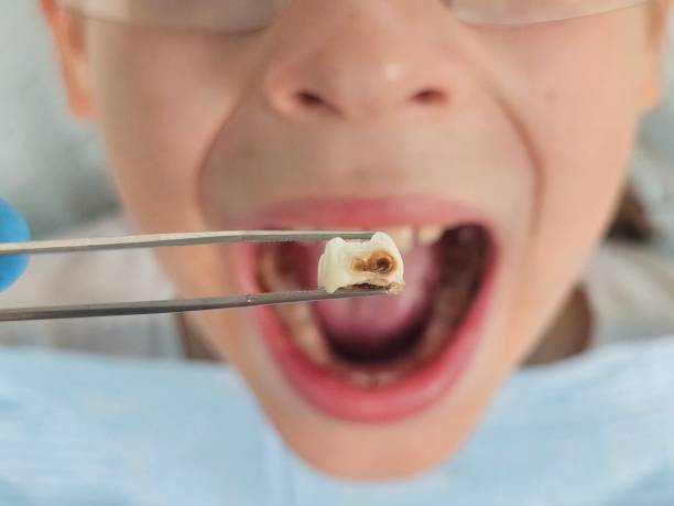 Best Emergency Tooth Extraction in Charleston, MO